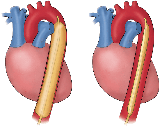 intraaortik-balon-pompasi